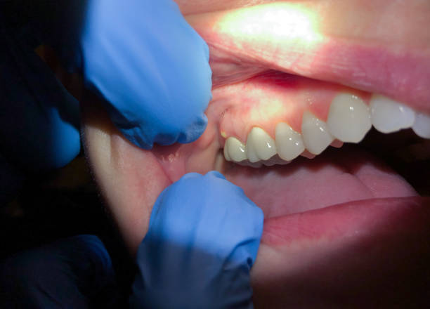 Best Knocked-Out Tooth Emergency  in Red Cloud, NE